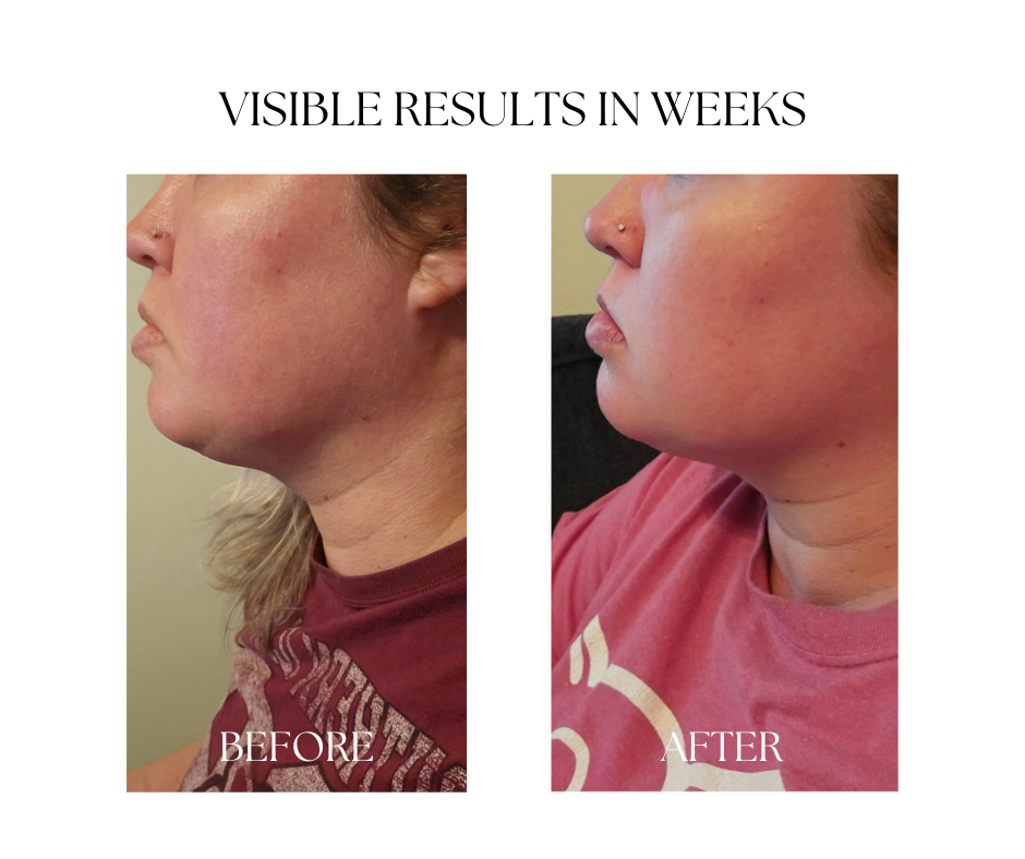 Redora Light Therapy Wand